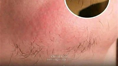 كابـوس شعر الذقن قد انتهى بدون ليزر