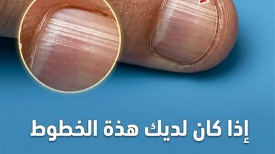 ماذا تعني الخطوط على الأظافر وأسباب ظهورها؟